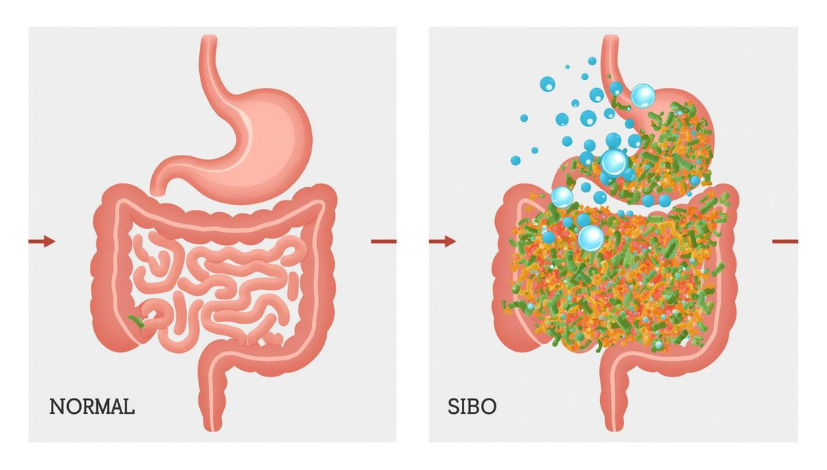 le SIBO illustrer avec l'intestin grêle sain versus une prolifération bactérienne anormale.